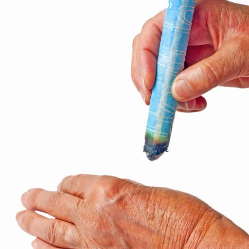 s-moxibustion
